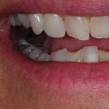 What is the hollywood smile in orthodontics?