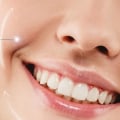 What is the smile line?