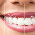 What is dental smile design?