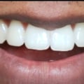 What is a smile line in dentistry?