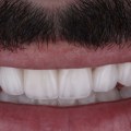 Is Hollywood Smile permanent?