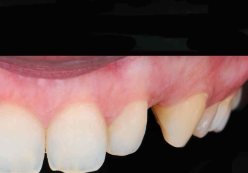 What is the cost of the smile design treatment?