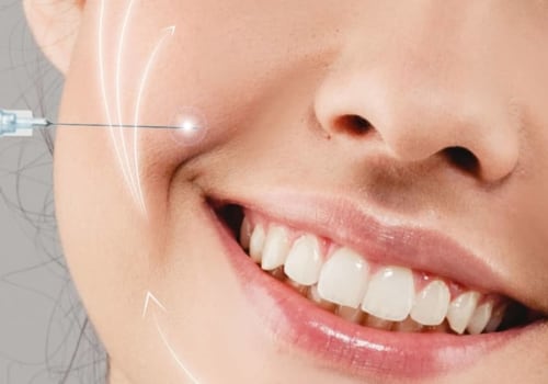 What is the smile line?