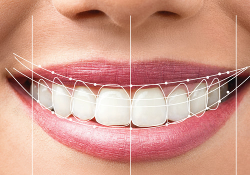 What is dental smile design?