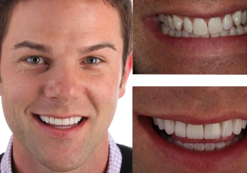 How does smile design work?